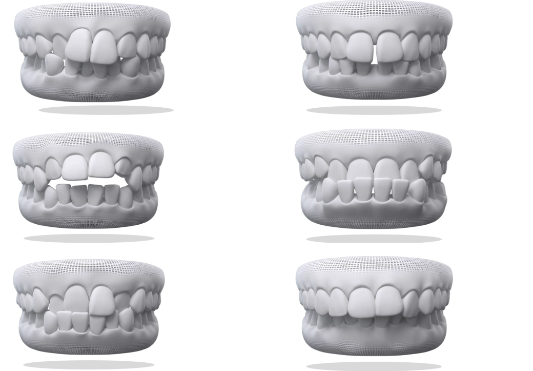 Misaligned teeth examples impacting Invisalign cost.