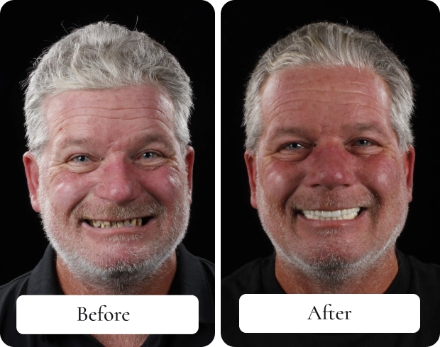 dental implants san luis obispo arroyo grande before and after